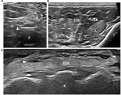 Frontiers High resolution ultrasound of peripheral neuropathies